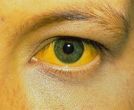 Желтуха – симптомы, причины, виды и лечение желтухи